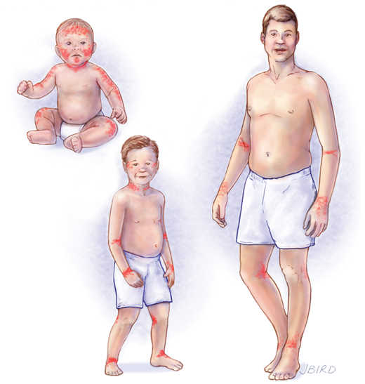 dermatitis-atopica-diagrama